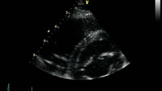 ARVC ARRHYTHMOGENIC RIGHT VENTRICULAR CARDIOMYOPATHY DAVD [upl. by Ailama]