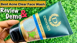 Denver Acne Clear Face Wash Review Benefits amp Demo [upl. by Attenwad]