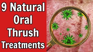 9 Natural Oral Thrush Treatments [upl. by Riamo178]