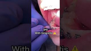 IPR with Gingivitis  Tooth Time Family Dentistry [upl. by Suchta727]