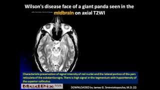 MedPix Week 666 Wilsons Disease from Kristin Kinsman Jeffrey Pollock MD Ryan Berecky MD [upl. by Neleb]