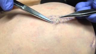 How to remove a running suture [upl. by Idner]