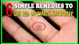 6 Simple Home Remedies To Get Rid Of Warts Naturally  Warts Removal  Best Home Remedies [upl. by Tedman239]