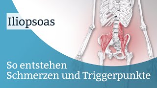 Iliopsoas Schmerzen Triggerpunkte und deren Aktivierung [upl. by Mcripley]