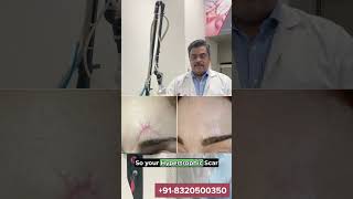 CO2 Fractional Laser Treatment  Keloid Scars  Dr Ashutosh Shah  Elegance Clinic  Surat [upl. by Etnahsal]