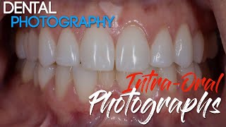 Dental Photography Basics  Dental Photography Techniques  Intraoral Photographs [upl. by Eikcuhc]