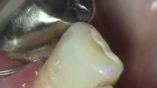 歯石 Tartar Dental calculus 牙結石 치석  新潟県長岡市・顕微鏡歯科 [upl. by Dehnel849]