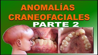 MALFORMACIONES CRANEOFACIALES O ANOMALIAS CONGENITAS DE DESARROLLO FACIAL PARTE 2 [upl. by Shuman620]