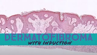 Dermatofibroma with induction phenomenon pathology dermpath dermatology dermatopathology [upl. by Canon]