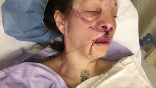 Jennifer Hiles 21717 AVM NYC surgery 11 update [upl. by Xonel]