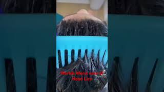 Worlds worst case of lice piojos liceremoval theliceangels licetreatment [upl. by Cookie]