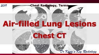 Air filled lung lesions CT Terms [upl. by Lolita]