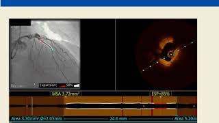 PCI with Novel SirolimusEluting Stent  Abluminus DES [upl. by Roid]