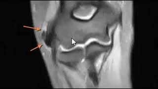 Calcific Tendinitis Elbow [upl. by Nylrehs]