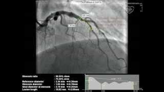 cateterismo y angiografiaavi [upl. by Inavihs]