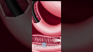 PreOp® Upper GI Endoscopy Patient Experience 👩‍⚕️ preop shorts health 🏥 [upl. by Aicatsanna]