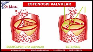 QX MEDIC  VALVULOPATIAS [upl. by Adham]