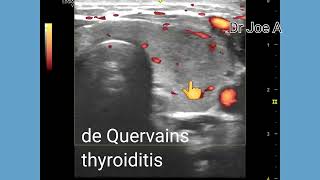 De Quervains thyroiditis or subacute granulomatous thyroiditis ultrasound and color Doppler video [upl. by Dopp]