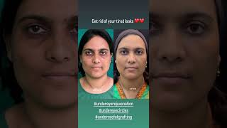 UNDEREYE HOLLOWNESSdranirbanghoshskincarebotoxcosmeticsurgery [upl. by Erme]