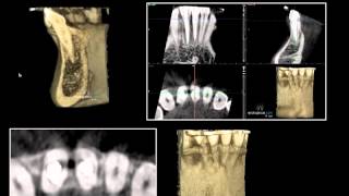 ENDOGALICIA trauma oclusal por interferencia en lateralidad [upl. by Clyve915]