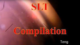 Selective Laser Trabeculoplasty SLT Compilation Chris Teng MD [upl. by Harlamert]