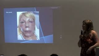 7“Hipersensibilidad de tipo 1 por fillers” Curso del Nuevo Milenio IMQ [upl. by Akkim991]