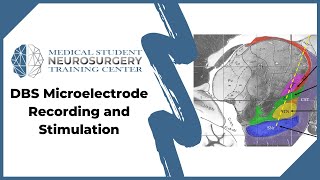 DBS Microelectrode Recording and Stimulation [upl. by Taryne]