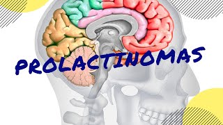 PROLACTINOMAS Causas síntomas diagnóstico y tratamiento [upl. by Soma]