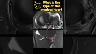 Fig 1B04 LongitudinalVertical Meniscal Tears with ACL tear [upl. by Ennayrb880]