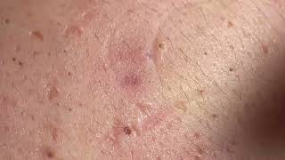 Acne Treatment Huong Da Nang  2024 blackheads 703 [upl. by Ainez]