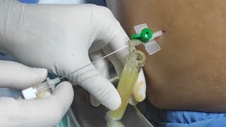 Remove abdominal fluid ascites  Paracentesis  Ascitic fluid aspiration [upl. by Karalee705]