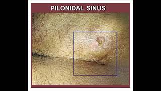 PILONIDAL SINUS [upl. by Forsyth559]