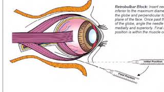 Retrobulbar block in dog prior to enucleation [upl. by Moses]