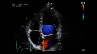 Pulmonary Stenosis [upl. by Ydoow367]