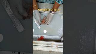 Atrophic uterus specimen அட்ராபிக் கருப்பை  biopsy satisfying pathology histopathology [upl. by Nylecaj22]