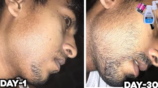 Mintop minoxidil से एक महीने में कितना दाढ़ी आएगा  minoxidil beard growth derma roller for beard [upl. by Meingoldas780]