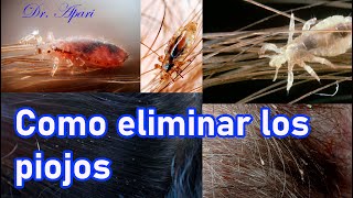 COMO ELIMINAR LOS PIOJOS  DR APARI [upl. by Meave]