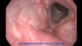 01 laryngeal activity before manipulation [upl. by Lindeberg]