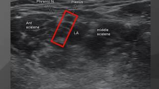 Webinar Continuous Interscalene Cath Placement Utilizing the quotHickman Flipquot [upl. by Viehmann]