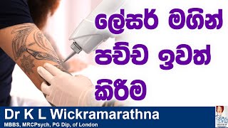 ලේසර් මගින් පච්ච ඉවත් කිරීම [upl. by Ahteres]