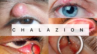 Chalazion  Ophthalmology  EASY MBBS [upl. by Armyn]