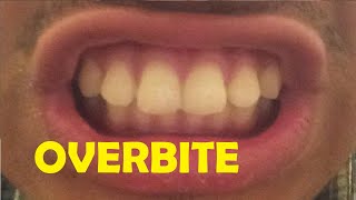 how to fix an overbite without braces [upl. by Edelsten]