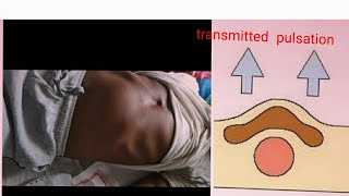 transmitted and expansile pulsation  Abdominal mass Transmitted pulstation expansile pulsation [upl. by Rowan]