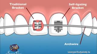 Vincent Team Orthodontics SelfLigating Braces [upl. by Won]