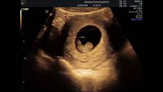 9 Weeks Ultrasound  8 weeks 4 days Technically [upl. by Lantz]