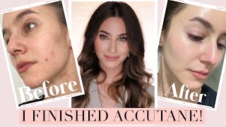 I FINISHED ACCUTANE 🎉 Results  Side Effects Low Dose Isotretinoin Journey  Karima McKimmie [upl. by Iretak]