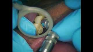 Dental Implants Dentsply Ankylos With Tryin Jig  2 of 7 [upl. by Pence955]