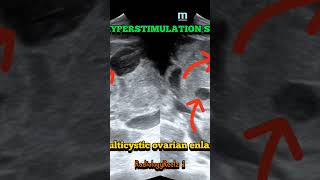 Ovarian Hyperstimulation syndrome fy fypyoutube study fypシ fypage foryou trending radiology [upl. by Radec84]