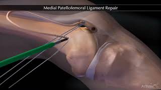 Reparation ligament fémoropatellaire MPFL  Chirurgie Instabilité de rotule  Dr Tournemine [upl. by Bicknell]