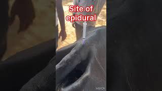 Site of epidural l dr Umar khan [upl. by Eiuqnom]